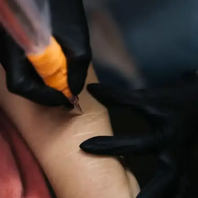 Stretch mark revision service designed to improve the appearance of skin texture at Inked Beauty Bar.